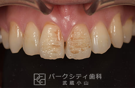 ラミネートベニア