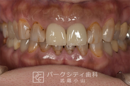 ジルコニアクラウンレイヤリングで修復